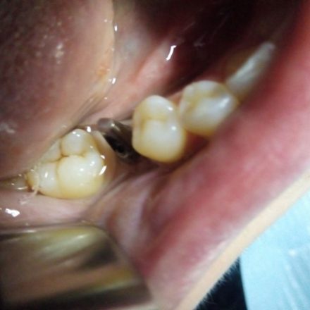 Implant Dentar 3