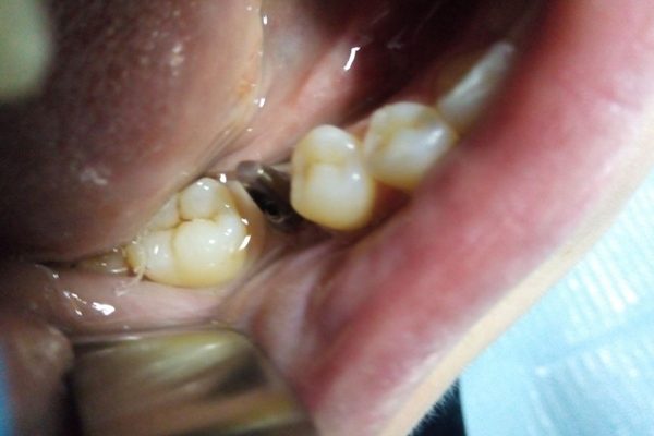 Implant Dentar 3