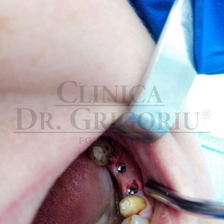 Implant Dentar 5