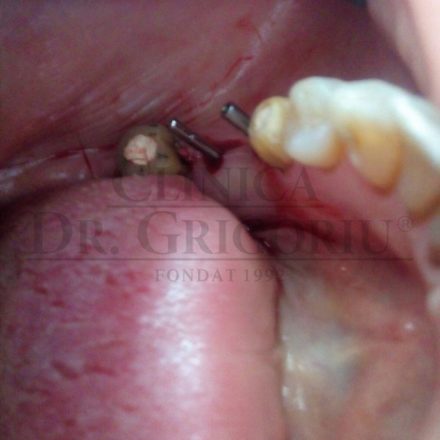 Implant Dentar 6